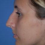 Rhinoplasty Before & After Patient #1586
