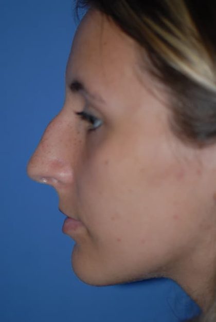 Rhinoplasty Before & After Patient #1586