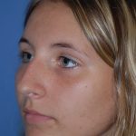 Rhinoplasty Before & After Patient #1586