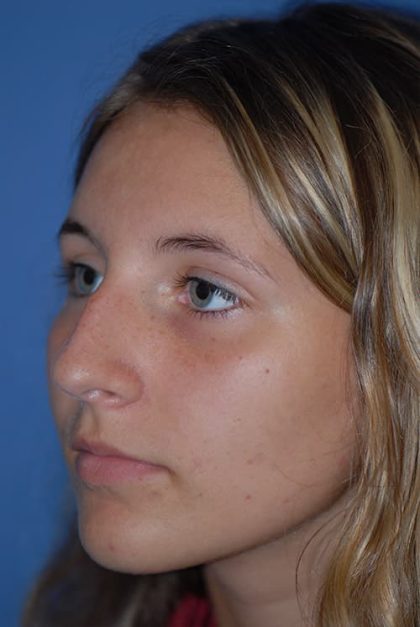 Rhinoplasty Before & After Patient #1586