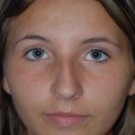Rhinoplasty Before & After Patient #1586