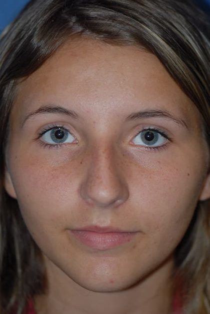 Rhinoplasty Before & After Patient #1586