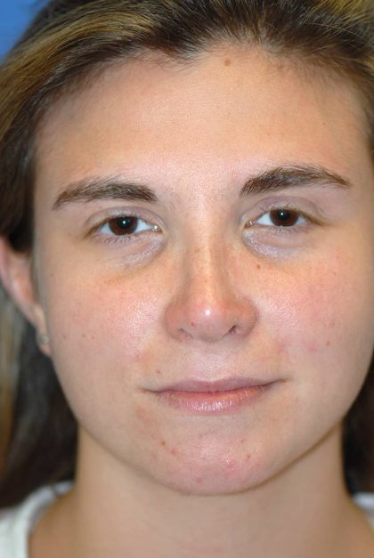 Rhinoplasty Before & After Patient #1585