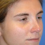 Rhinoplasty Before & After Patient #1585