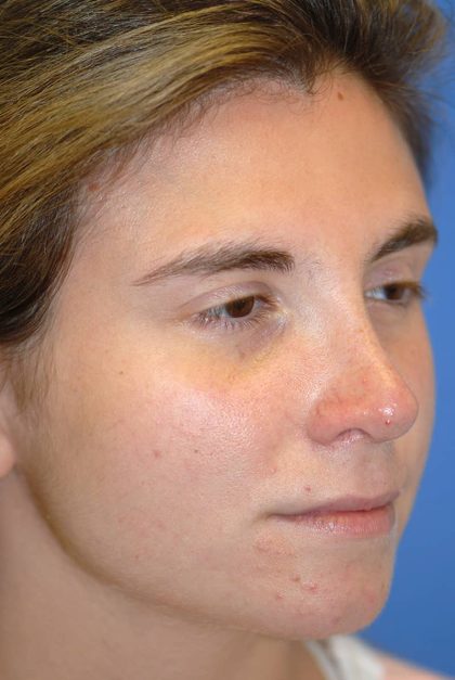 Rhinoplasty Before & After Patient #1585