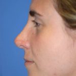 Rhinoplasty Before & After Patient #1585