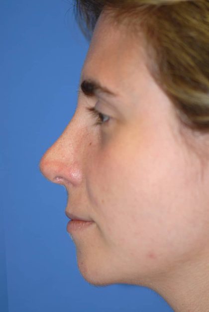 Rhinoplasty Before & After Patient #1585