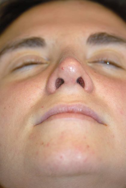 Rhinoplasty Before & After Patient #1585