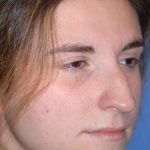 Rhinoplasty Before & After Patient #1585