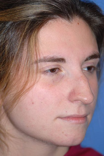 Rhinoplasty Before & After Patient #1585