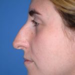 Rhinoplasty Before & After Patient #1585