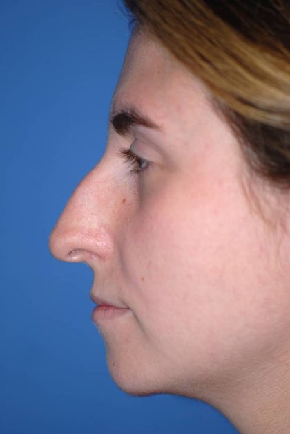 Rhinoplasty Before & After Patient #1585