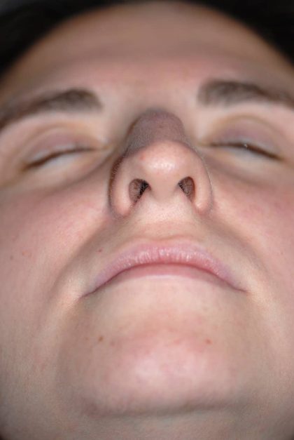 Rhinoplasty Before & After Patient #1585
