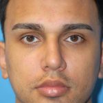 Rhinoplasty Before & After Patient #1584