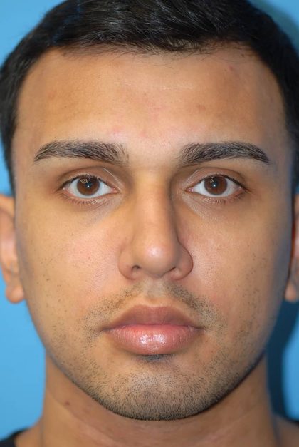 Rhinoplasty Before & After Patient #1584