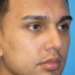 Rhinoplasty Before & After Patient #1584
