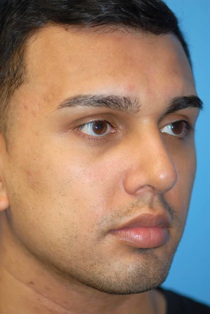 Rhinoplasty Before & After Patient #1584