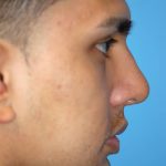 Rhinoplasty Before & After Patient #1584