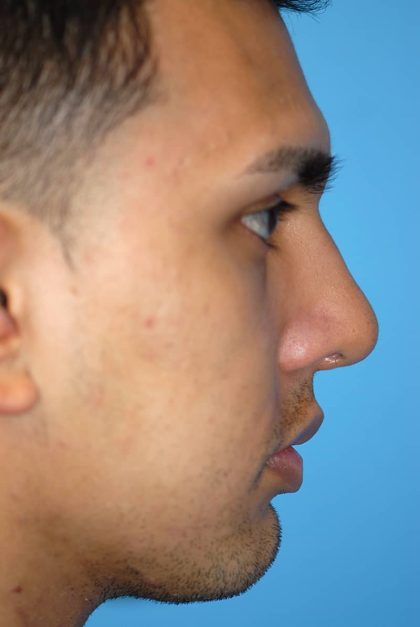 Rhinoplasty Before & After Patient #1584
