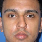 Rhinoplasty Before & After Patient #1584