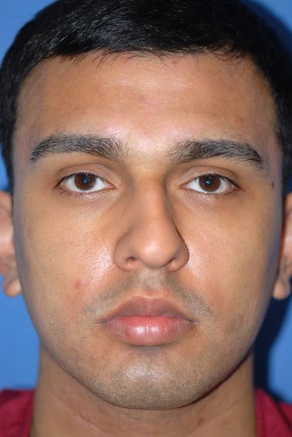 Rhinoplasty Before & After Patient #1584