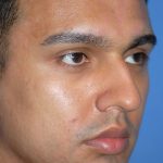 Rhinoplasty Before & After Patient #1584