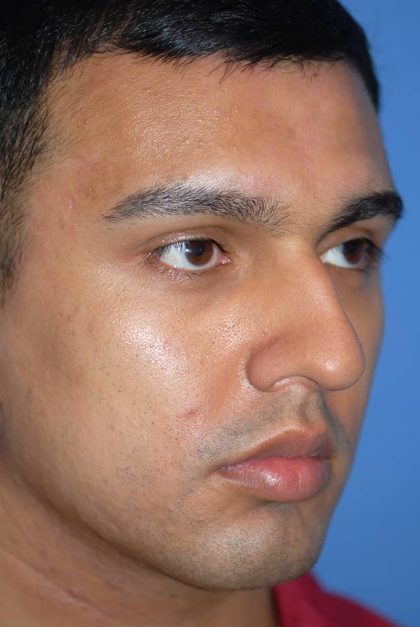 Rhinoplasty Before & After Patient #1584