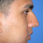 Rhinoplasty Before & After Patient #1584