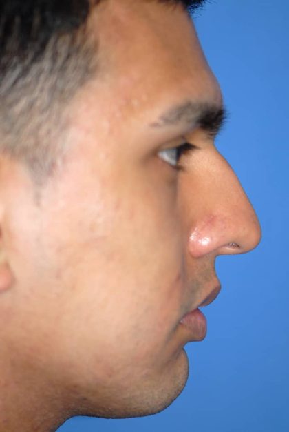 Rhinoplasty Before & After Patient #1584