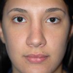 Rhinoplasty Before & After Patient #1583