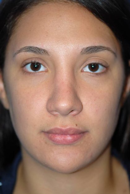 Rhinoplasty Before & After Patient #1583