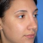 Rhinoplasty Before & After Patient #1583