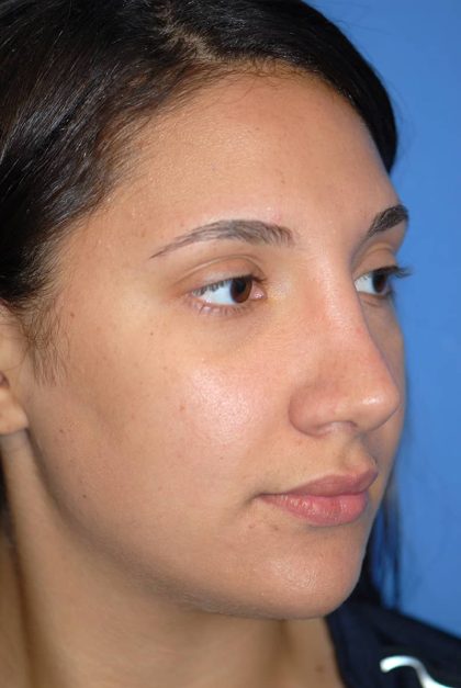 Rhinoplasty Before & After Patient #1583