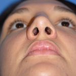 Rhinoplasty Before & After Patient #1583