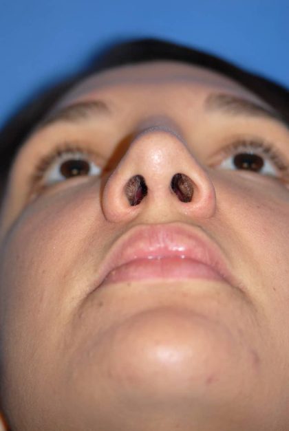 Rhinoplasty Before & After Patient #1583