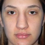 Rhinoplasty Before & After Patient #1583