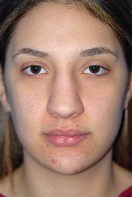 Rhinoplasty Before & After Patient #1583