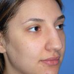 Rhinoplasty Before & After Patient #1583