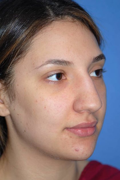 Rhinoplasty Before & After Patient #1583