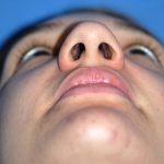 Rhinoplasty Before & After Patient #1583