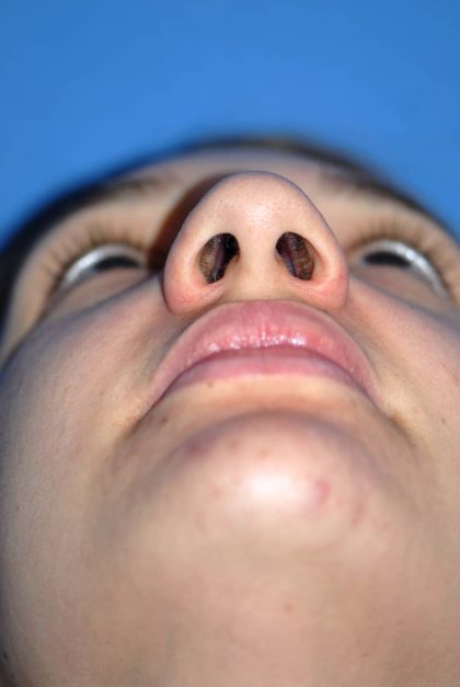 Rhinoplasty Before & After Patient #1583