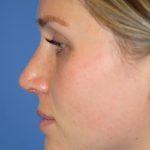 Rhinoplasty Before & After Patient #1582