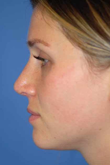 Rhinoplasty Before & After Patient #1582