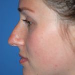 Rhinoplasty Before & After Patient #1582