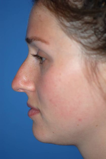 Rhinoplasty Before & After Patient #1582