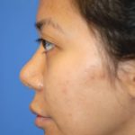 Rhinoplasty Before & After Patient #1581