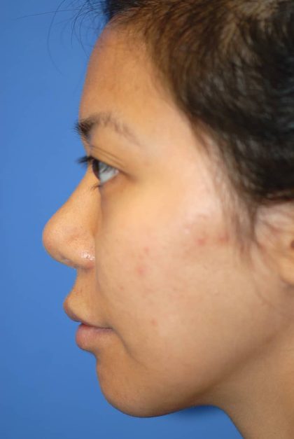 Rhinoplasty Before & After Patient #1581