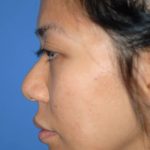 Rhinoplasty Before & After Patient #1581