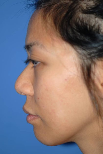 Rhinoplasty Before & After Patient #1581
