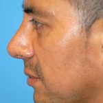 Rhinoplasty Before & After Patient #1580